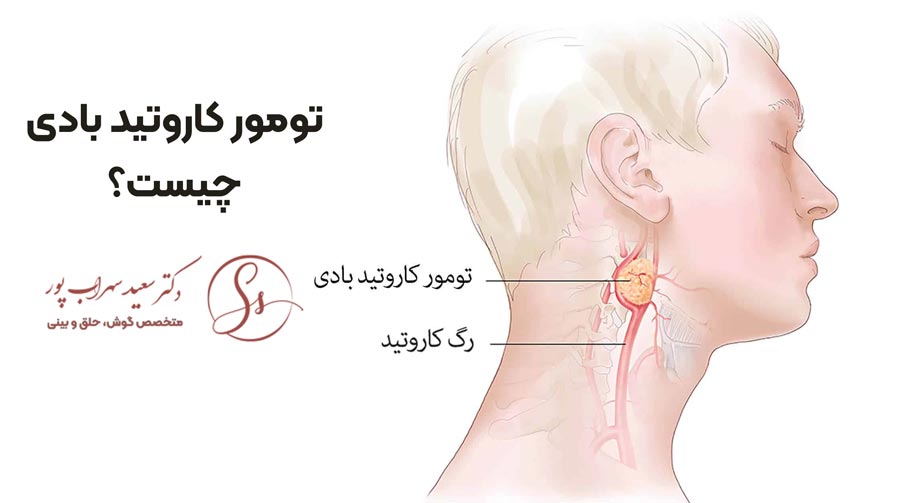 تومور کاروتید بادی