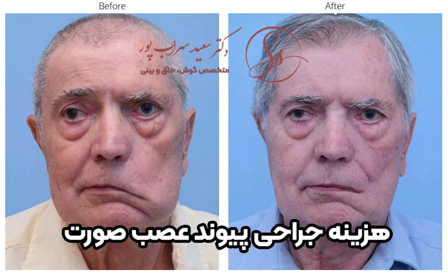 هزینه جراحی پیوند عصب صورت