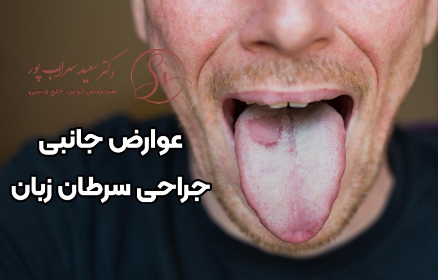 عوارض جانبی جراحی سرطان زبان