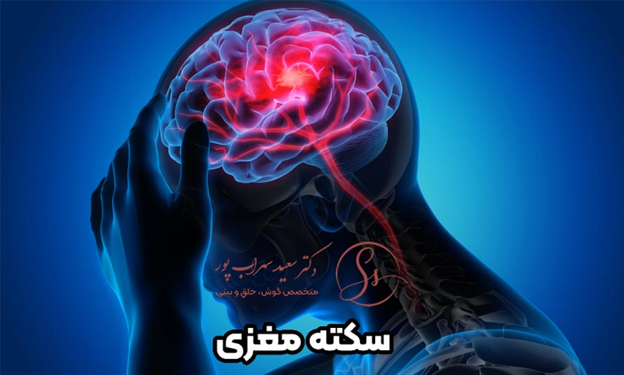 سکته مغزی