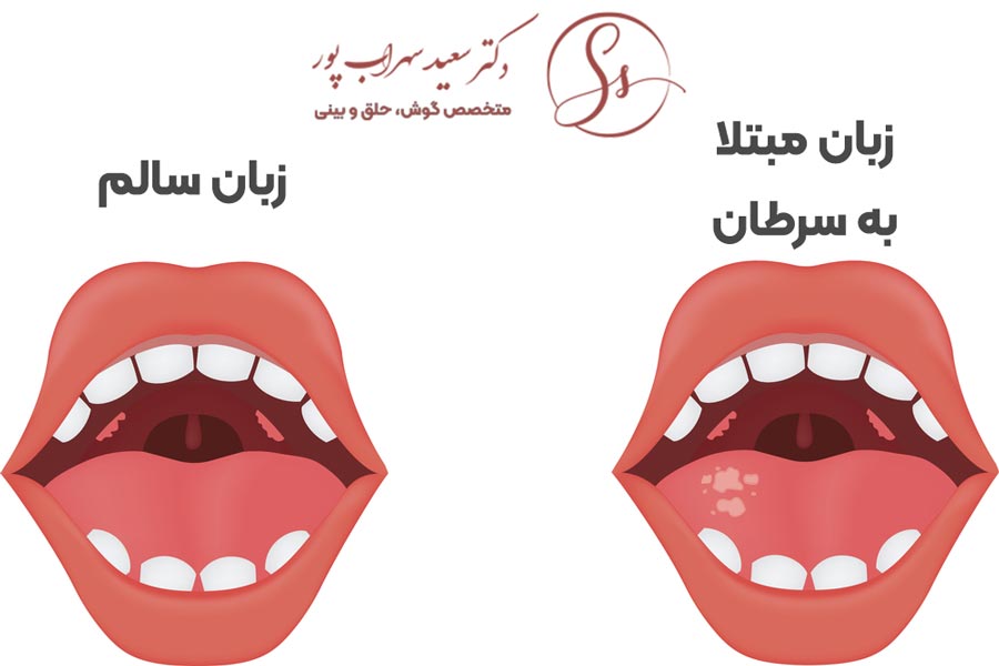 علائم سرطان زبان