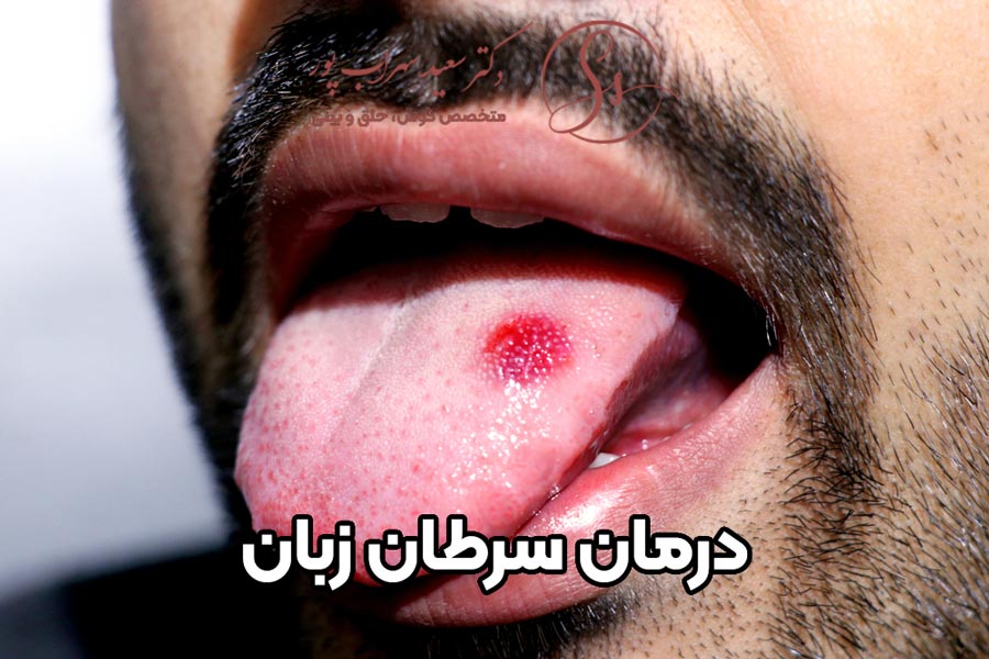 درمان سرطان زبان