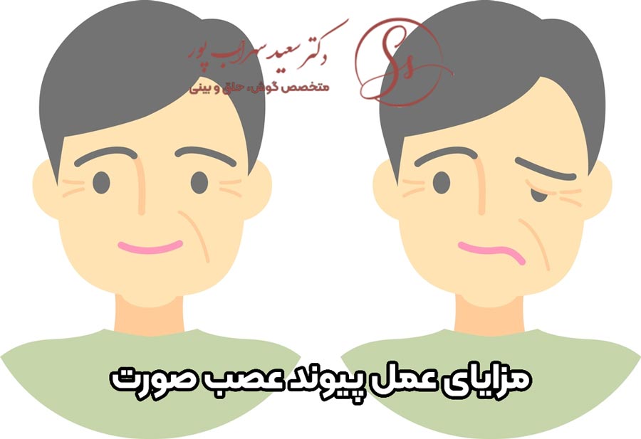 مزایای عمل پیوند عصب صورت