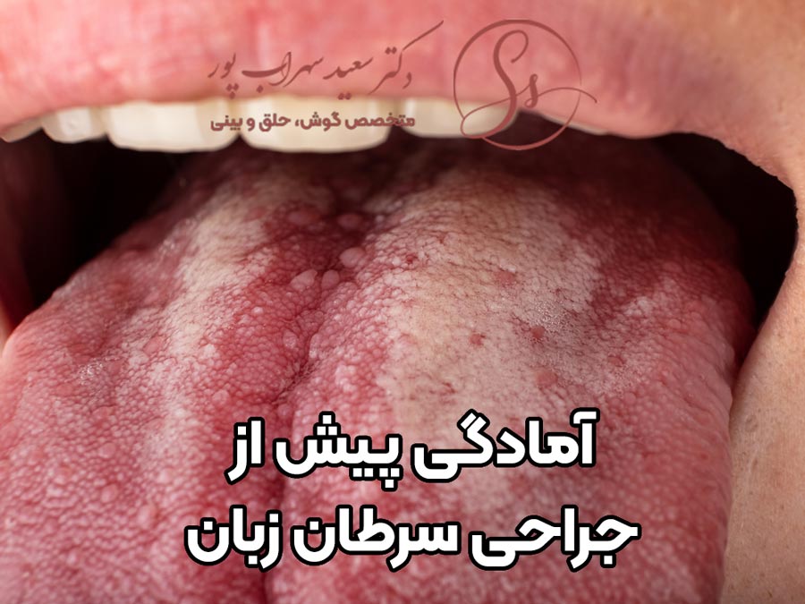 آمادگی پیش از جراحی سرطان زبان