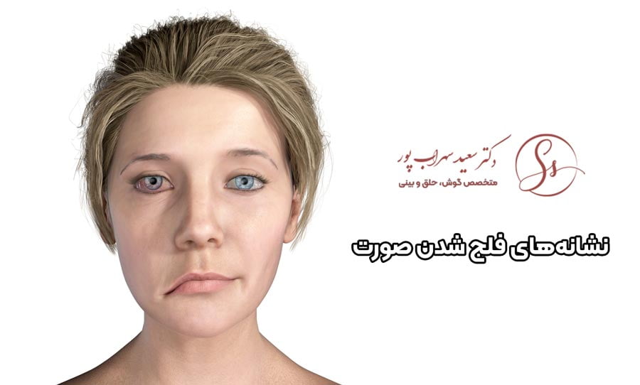 نشانه های فلج شدن صورت