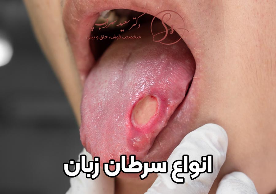 انواع سرطان زبان