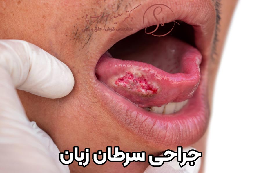جراحی سرطان زبان