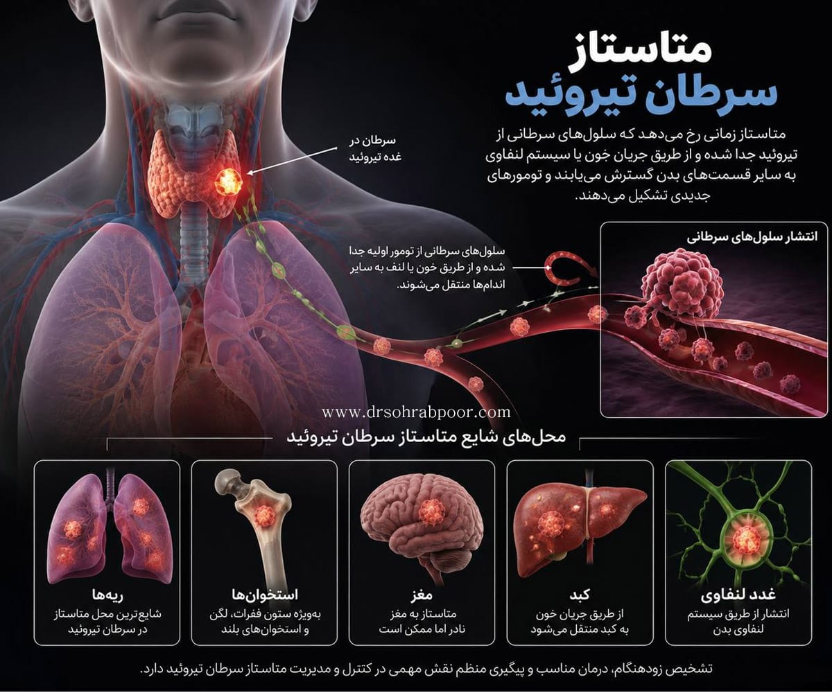 متاستاز سرطان تیروئید + دکتر سعید سهراب پور